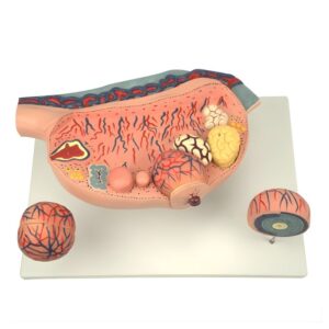Enlarged Ovary